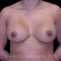 Breast Augmentation Before & After Patient #8863
