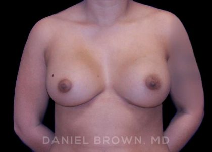 Breast Augmentation Before & After Patient #8863