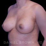 Breast Augmentation Before & After Patient #8863
