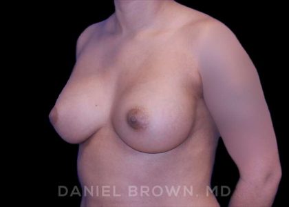 Breast Augmentation Before & After Patient #8863