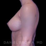 Breast Augmentation Before & After Patient #8863