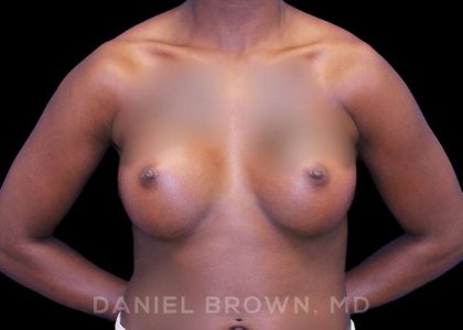 Breast Augmentation Before & After Patient #8863