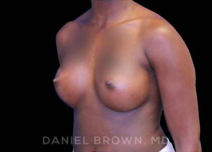 Breast Augmentation Before & After Patient #8863