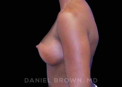 Breast Augmentation Before & After Patient #8863