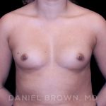 Breast Augmentation Before & After Patient #8863