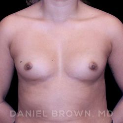 Breast Augmentation Before & After Patient #8863