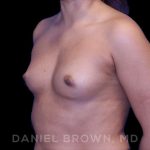 Breast Augmentation Before & After Patient #8863