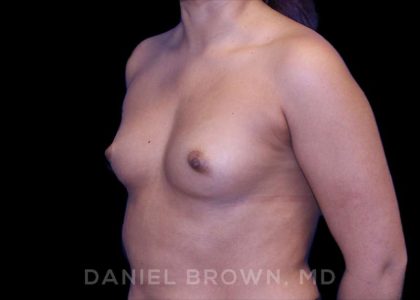Breast Augmentation Before & After Patient #8863