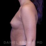 Breast Augmentation Before & After Patient #8863