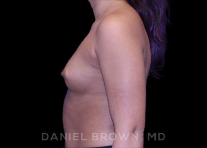 Breast Augmentation Before & After Patient #8863
