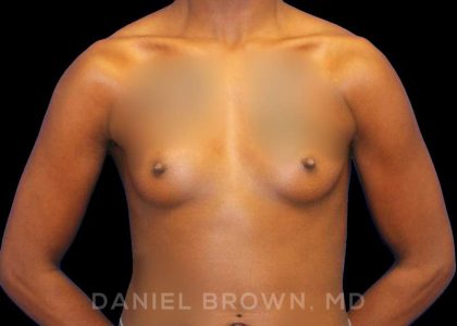 Breast Augmentation Before & After Patient #8863