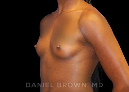 Breast Augmentation Before & After Patient #8863