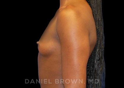 Breast Augmentation Before & After Patient #8863