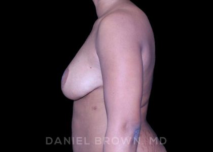 Bellesoma Breast Lift Before & After Patient #8390