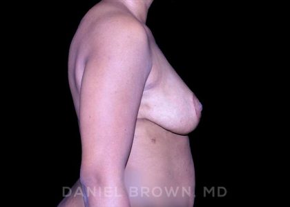 Bellesoma Breast Lift Before & After Patient #8390