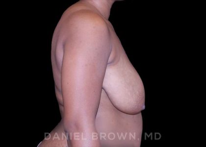 Bellesoma Breast Lift Before & After Patient #8390