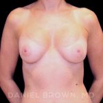 Breast Augmentation Before & After Patient #8870