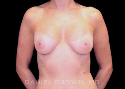 Breast Augmentation Before & After Patient #8870