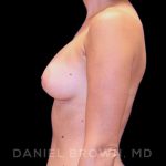 Breast Augmentation Before & After Patient #8870
