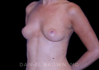 Breast Augmentation Before & After Patient #8870