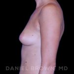 Breast Augmentation Before & After Patient #8870