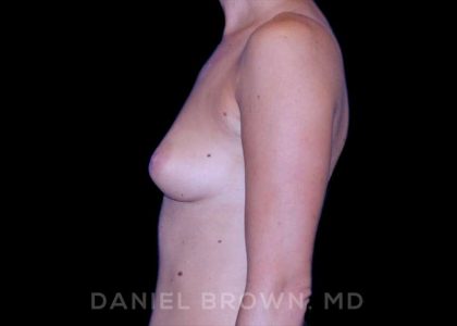 Breast Augmentation Before & After Patient #8870