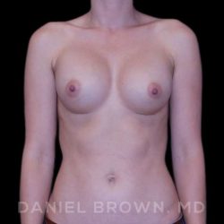 Breast Augmentation Before & After Patient #8877