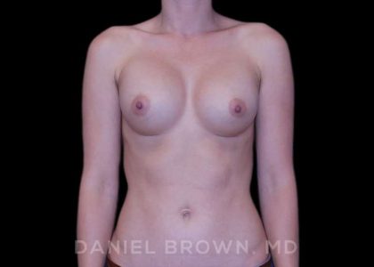 Breast Augmentation Before & After Patient #8877