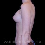 Breast Augmentation Before & After Patient #8877