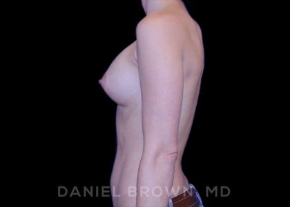 Breast Augmentation Before & After Patient #8877