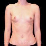 Breast Augmentation Before & After Patient #8877