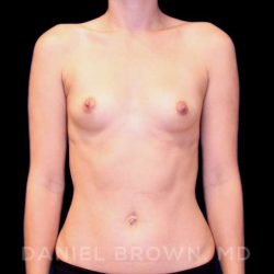 Breast Augmentation Before & After Patient #8877