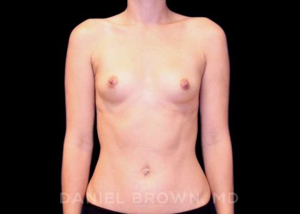 Breast Augmentation Before & After Patient #8877