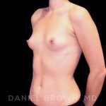 Breast Augmentation Before & After Patient #8877