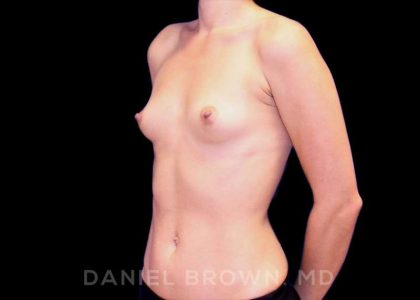 Breast Augmentation Before & After Patient #8877