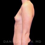 Breast Augmentation Before & After Patient #8877