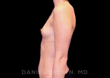 Breast Augmentation Before & After Patient #8877