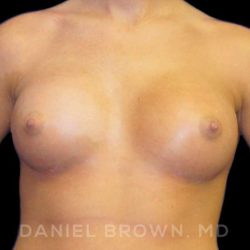 Breast Augmentation Before & After Patient #8888