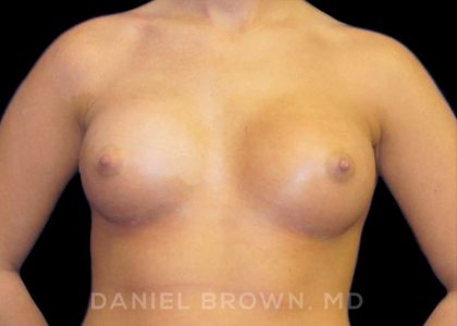 Breast Augmentation Before & After Patient #8888