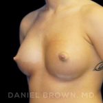 Breast Augmentation Before & After Patient #8888