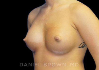 Breast Augmentation Before & After Patient #8888