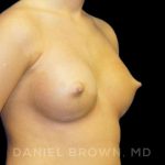 Breast Augmentation Before & After Patient #8888