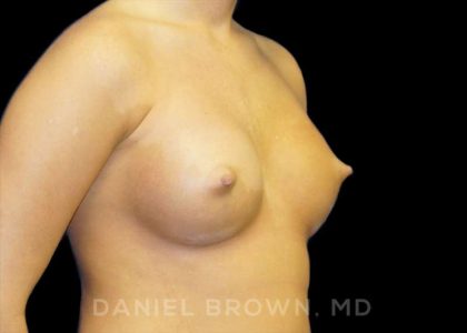 Breast Augmentation Before & After Patient #8888