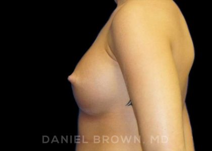 Breast Augmentation Before & After Patient #8888