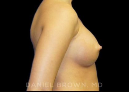 Breast Augmentation Before & After Patient #8888