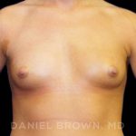 Breast Augmentation Before & After Patient #8888