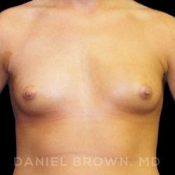 Breast Augmentation Before & After Patient #8888