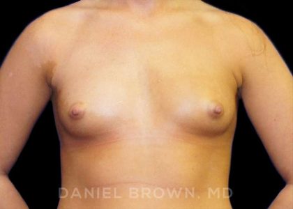 Breast Augmentation Before & After Patient #8888