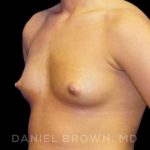 Breast Augmentation Before & After Patient #8888