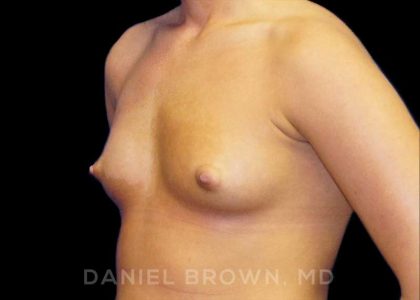 Breast Augmentation Before & After Patient #8888